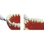 INSERT D'EMBOUT À ULTRASONS EN ACIER INOXYDABLE ET TITANE SATELEC BADER® DENTAL G6 – Image 3