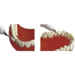 INSERÇÃO DE PONTA ULTRASSÓNICA EM AÇO INOXIDÁVEL EMS BADER® DENTAL G2 - Image 3