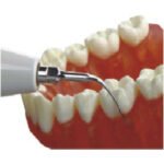 INSERÇÃO DE PONTA ULTRASSÓNICA EM AÇO INOXIDÁVEL EMS BADER® DENTAL G5 - Image 4