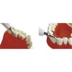 WKŁADKA ULTRADŹWIĘKOWA ZE STALI NIERDZEWNEJ I TYTANU EMS BADER® DENTAL G1 - obrazek 3