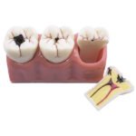 Usuwalny model próchnicy BADER® DENTAL®