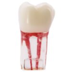 Molar com canais radiculares de Bader - Image 2