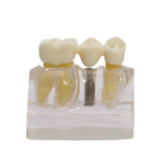 Modelo de demonstração de implante BADER® DENTAL - Image 3