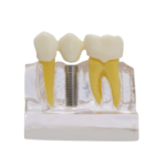 Modelo de demonstração de implante BADER® DENTAL - Image 4