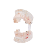 Modelo dentário transparente com implante BADER® DENTAL® - Image 3