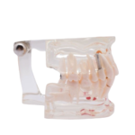 Modelo dentário transparente com implante BADER® DENTAL® - Image 4