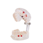 Modelo dentário de cárie transparente - Image 2