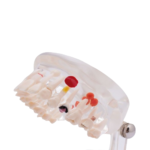 Modelo dentário de cárie transparente - Image 3