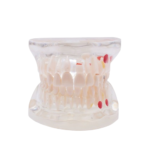Modelo dentário de cárie transparente - Image 4