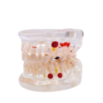Modelo dentário de cárie transparente