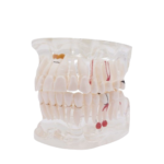 Modelo dentário transparente com implante BADER® DENTAL®